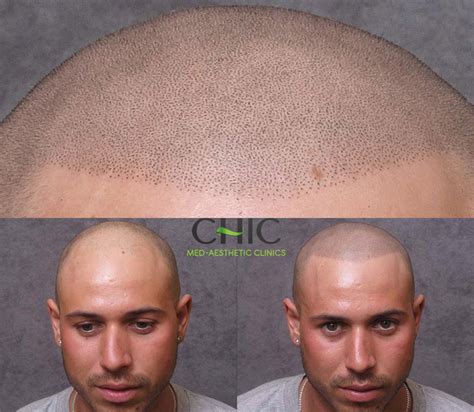scalp micropigmentation wimbledon|Scalp Micropigmentation in Worldwide • Check Prices & Reviews.